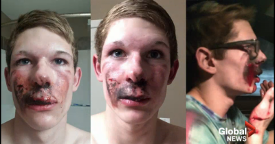 Canadian Teen Suffers Second Degree Burns After E-Cigarette Explodes In His Mouth.