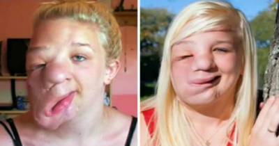 Girl Bullied For Droopy Face Caused By Tumor Has Life-Changing Surgery
