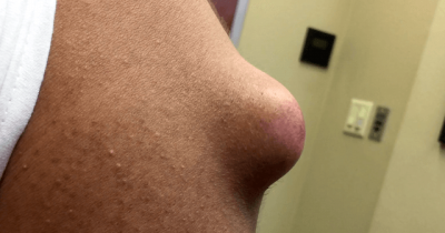 Dr. Pimple Popper Pops A Huge 'Doorknob' Of An Arm Cyst And It Comes Out Beautifully