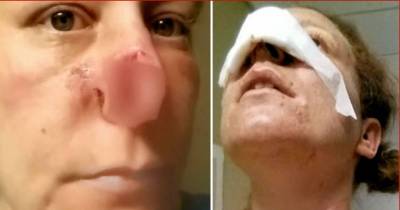 After The Break Up Her Ex-Boyfriend Bit Her Nose Off
