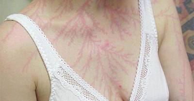 What Happens To Your Body When You&rsquo;re Hit By Lightning