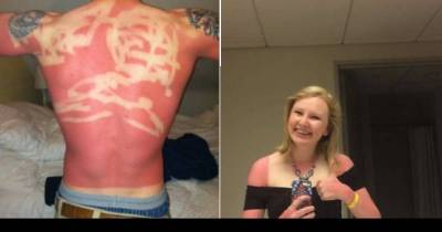 People Who Probably Shouldn't Have Forgotten Their Sunscreen