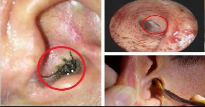 The Strangest And Grossest Things Doctors Have Found Inside Their Patient&rsquo;s Ears