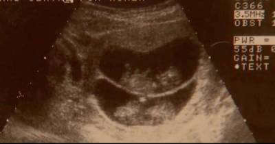 Doctor Sees &lsquo;Normal&rsquo; Twins On Sonogram, But Mom Is Stunned When She Sees Their Faces