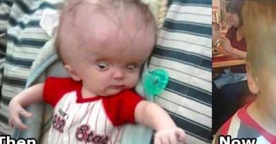 This Baby Was Born With A Swollen Head But Look At Him Now 6 Years Later.