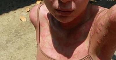 After This Teen's Dad Suddenly Died, She Woke Up To Find Mysterious Red Spots All Over Her Body