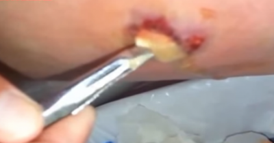 It Looks Like He&rsquo;s Pulling String Cheese Out Of His Elbow Cyst, And That Leads To A Gush Of Pus