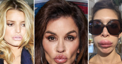 Celebrities Who Completely Destroyed Their Lips