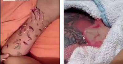 Horrific Infected Tattoo Leakage Is Too Nasty For Words
