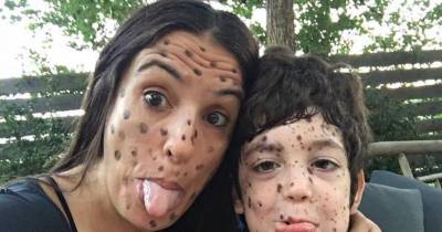 Her Boy Was Bullied For Dots On His Skin, What The Mum Replied Has Gone Viral