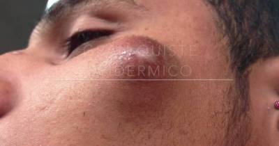 This Terrible Face Cyst Bursts From The First Cut And It&rsquo;s One Explosion Of Goo After Another