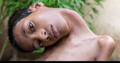 Tragic End For The Boy Born With His Head Upside-Down, Just 8 Months After Surgery