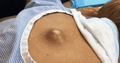 Draining This Massive Cyst Was Challenging