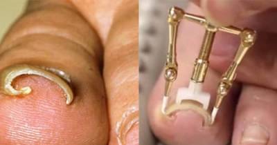 7 Steps To Painlessly Remove Your Ingrown Toenail