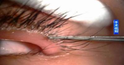 When She Complains Of Constant Eye Slime, Doctors Discover The Cause