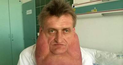 This Man&rsquo;s Chin Suddenly Grew To Weigh 15 Pounds And Now Look At Him