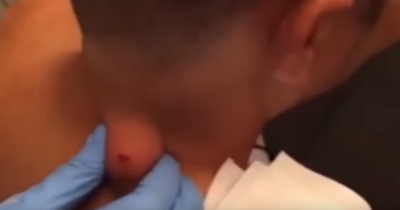 Be Warned: This Zit Comes Jumping Out Of This Neck, And Someone Has A Cleaning Bill