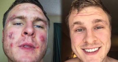 This Man With Severe Acne Reveals His Secret To Unbelievable Skin