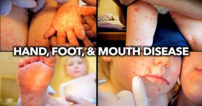 There's A Rise In Hand-Foot-Mouth Disease