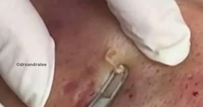 Thick White Pus Spurts From Guy&rsquo;s Acne In Extreme Spot Popping Mission