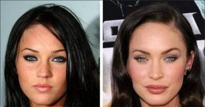 10 Stunning Celebs: Before And After Cosmetic Surgery.