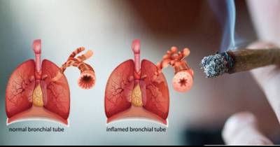Think Smoking Marijuana Is Bad For Your Lungs? 3 Reasons It Could Be A Good Idea