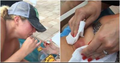 Can You Stomach Watching This Woman's Massive Pimple Being Popped By Her Friends At Poolside