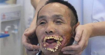 Man Who Had Face Ripped Apart By Wolf 56 Years Ago Finally Gets Corrective Surgery