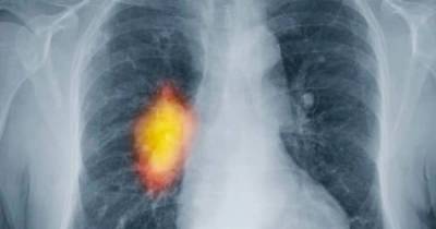7 Early Warning Signs That Cancer Is Growing In Your Body