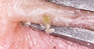 Extreme Close Up Of Blackheads Being Squeezed From A Patient's Face With Tweezers
