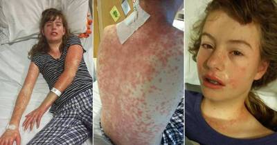 Mystery Illness Left Her Vomiting, Bleeding And Covered In A Rash 10 Weeks After A Holiday In Menorca