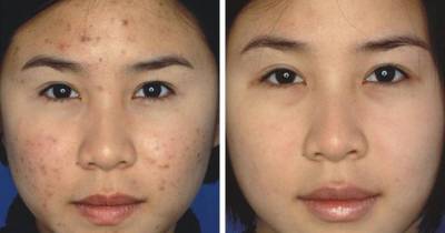How To Remove Any Scar In Less Than 30 Days