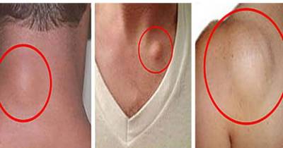 The Recipe For Natural Removal Of Fatty Tissue Within 8 Days