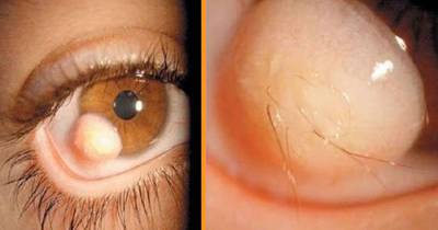 12 Strange Things That Can Happen To Your Eyes