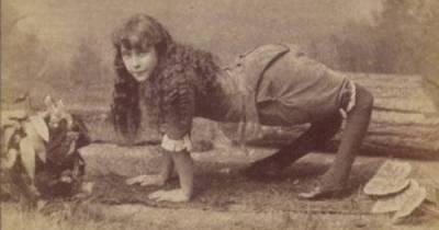 This Bizarre Medical Condition Forces Some People To Walk On All Fours