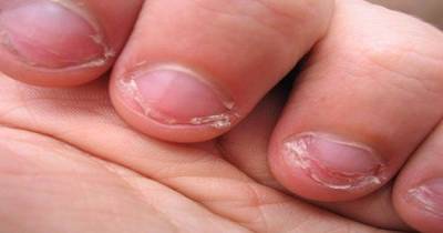 Doctor Says That The People Who Bite Their Nails Have Specific Personality Traits