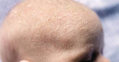 How To Manage Cradle Cap