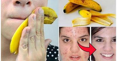 Amazing Benefits Of Banana Peels That Most Of Us Didn&rsquo;t Know