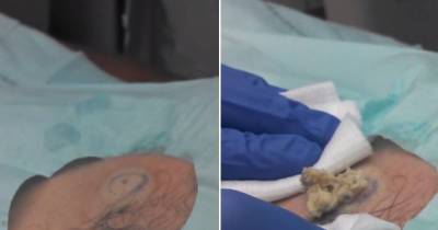 Surgeon Pops His Blackhead But It Was Actually A Giant Cyst