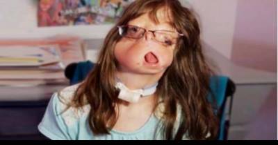 Girl Born Without A Face Becomes An Inspiration