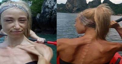 This Anorexic Woman Tried Bodybuilding To Save Her Life