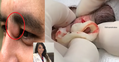 Dr. Pimple Popper Squeezes Giant Cyst On Mans Eye