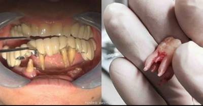 Dentists Share The Most Horrifying Things They&rsquo;ve Ever Seen At Work