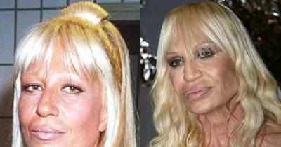 Celebs Who Went Into Hiding After Plastic Surgeries Gone Wrong