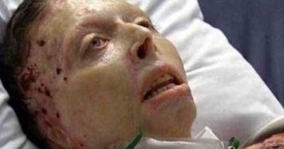 Boyfriend Who Set Girlfriend On Fire Gets Shocking Sentence