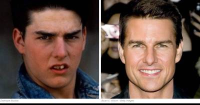 13 Fake Teeth Celebs: Before And After
