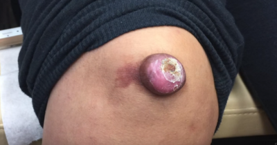 Dr. Pimple Popper Collected Her Best Removals Of 2016 Into The Greatest Video Of All Time