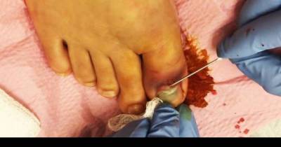 Girl&rsquo;s Toe Needs To Be Drained After Dropping A Keg On It