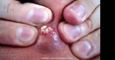 These May Not Look Like It, But They're Actually Pimples