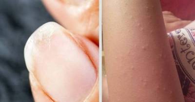 Start Eating More Iron Right Away If You Experience Any Of These 10 Signs Of Anemia